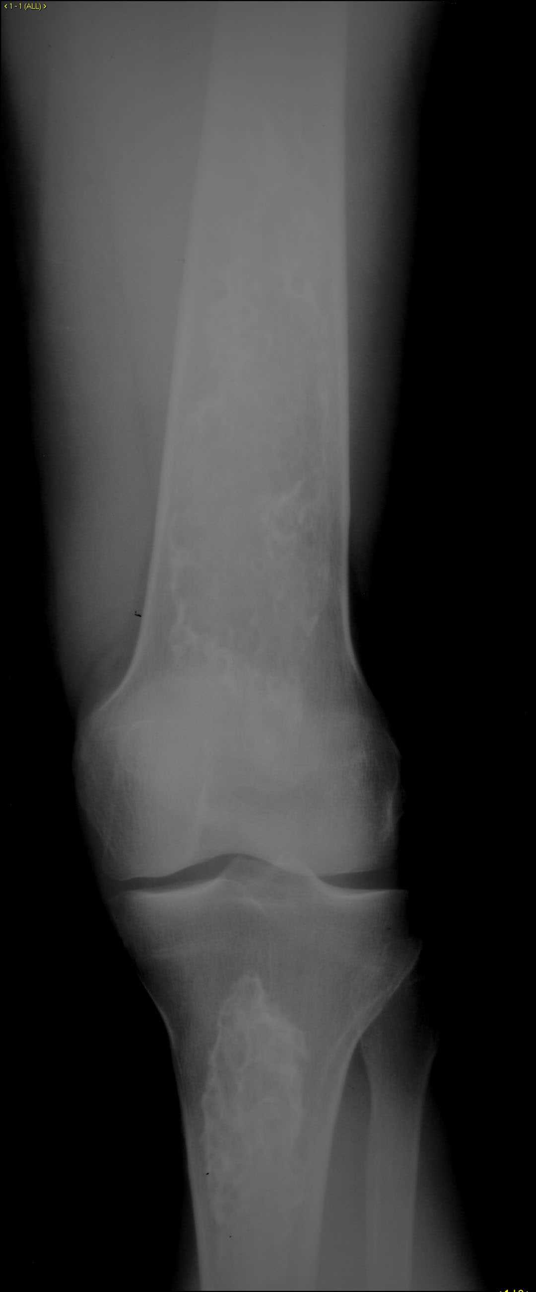Bone infarcts - CTisus CT Scan