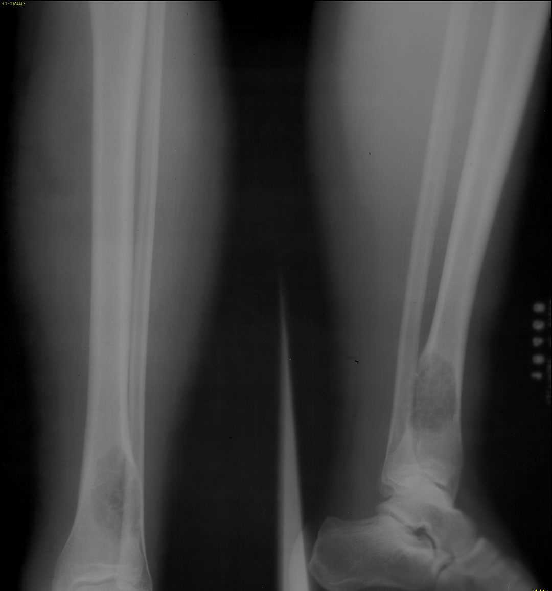 Nonossifying Fibroma - CTisus CT Scan