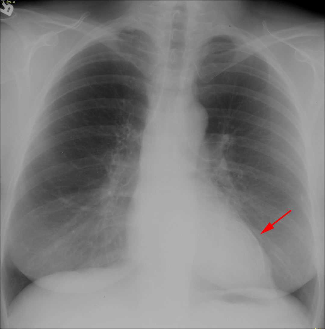 Left ventricular aneurysm - CTisus CT Scan