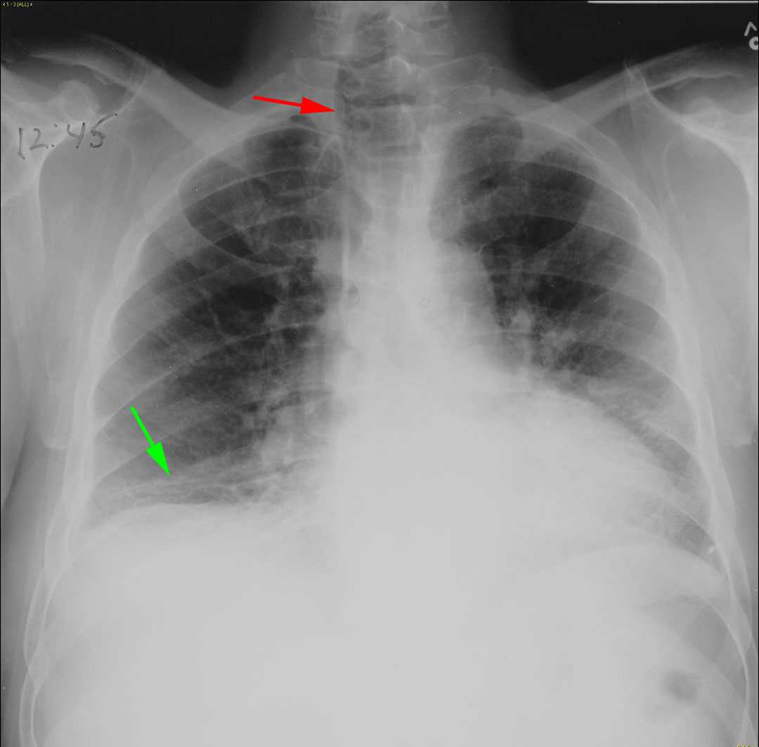Scleroderma - CTisus CT Scan