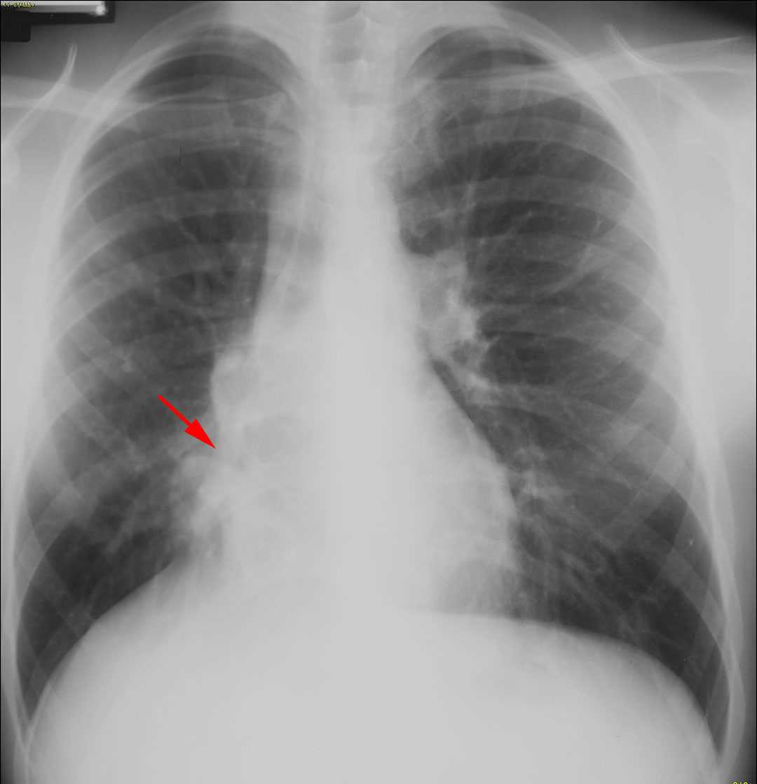 Scimitar Syndrome - CTisus CT Scan