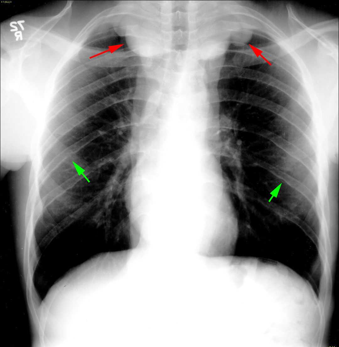 Neurofibromatosis - CTisus CT Scan