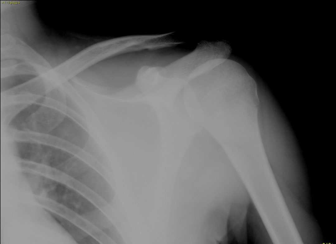 Coracoid process fracture - CTisus CT Scan