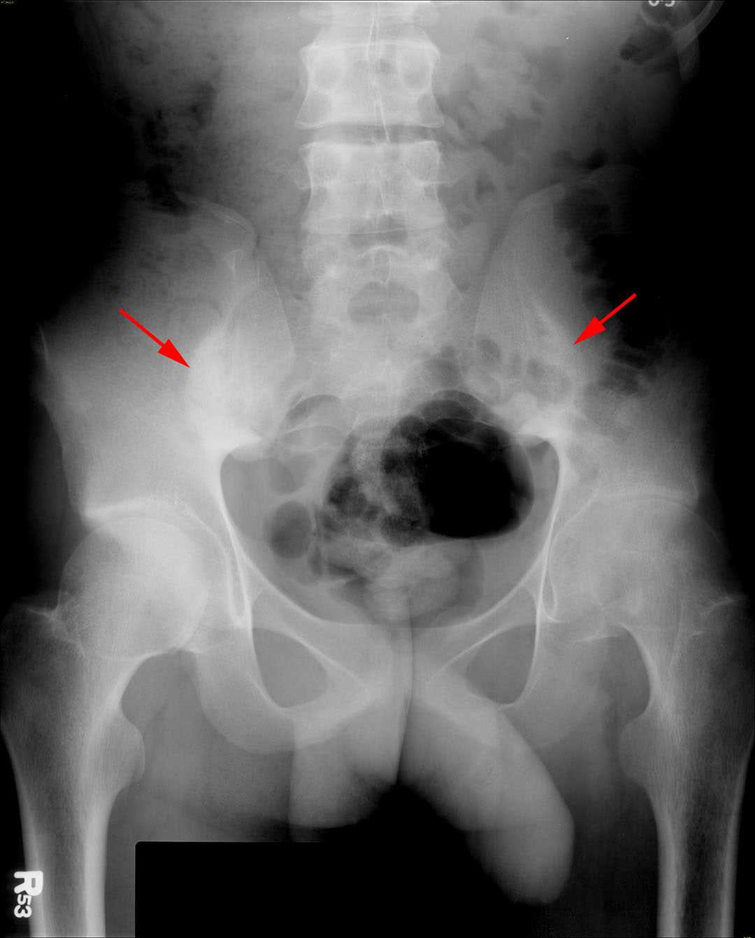 Ankylosing spondylitis - CTisus CT Scan