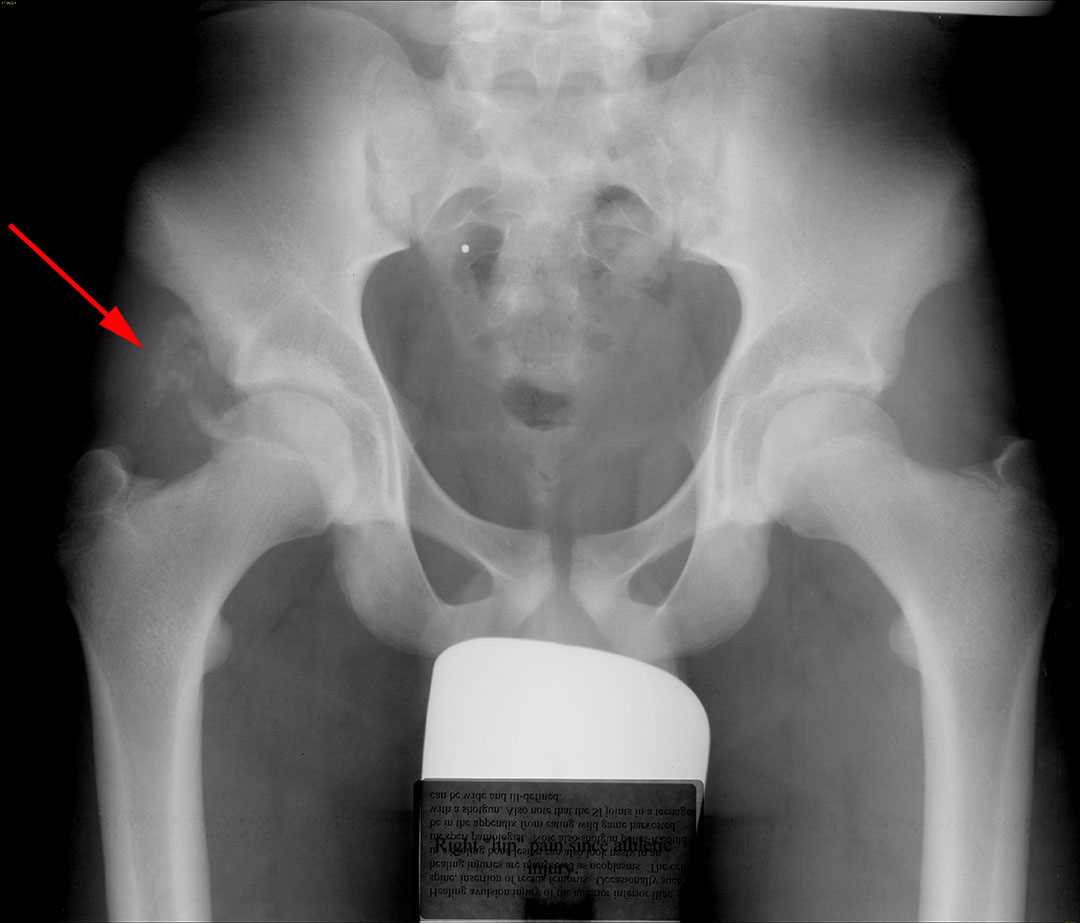 Anterior inferior iliac spine avulsion - CTisus CT Scan