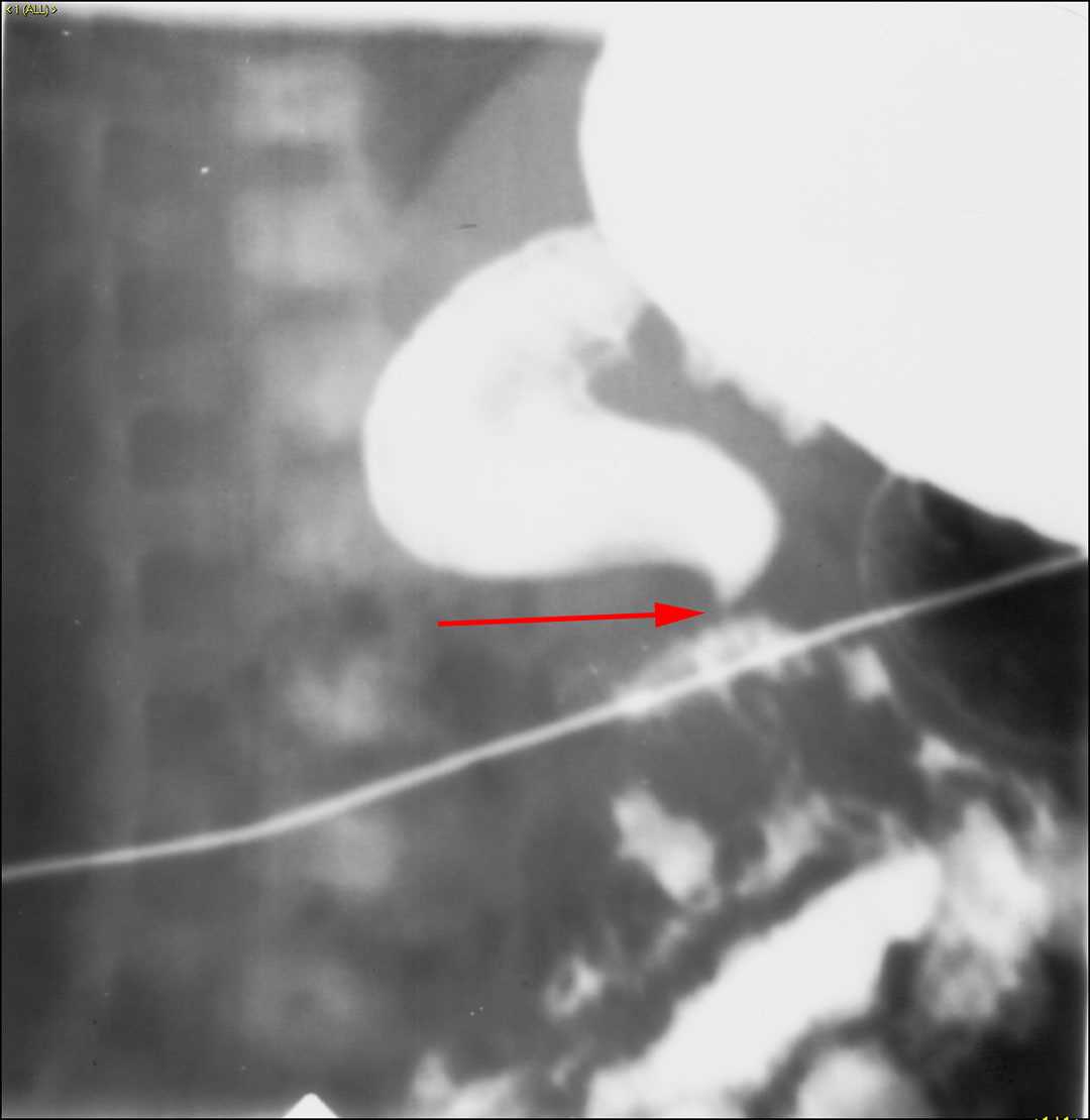 Midgut malrotation with volvulus - CTisus CT Scan