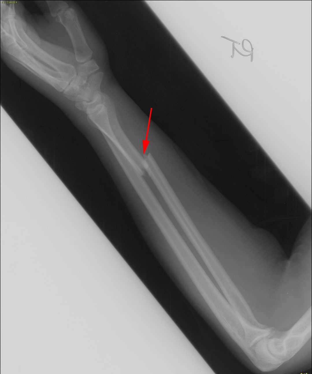 Galeazzi Fracture - CTisus CT Scan