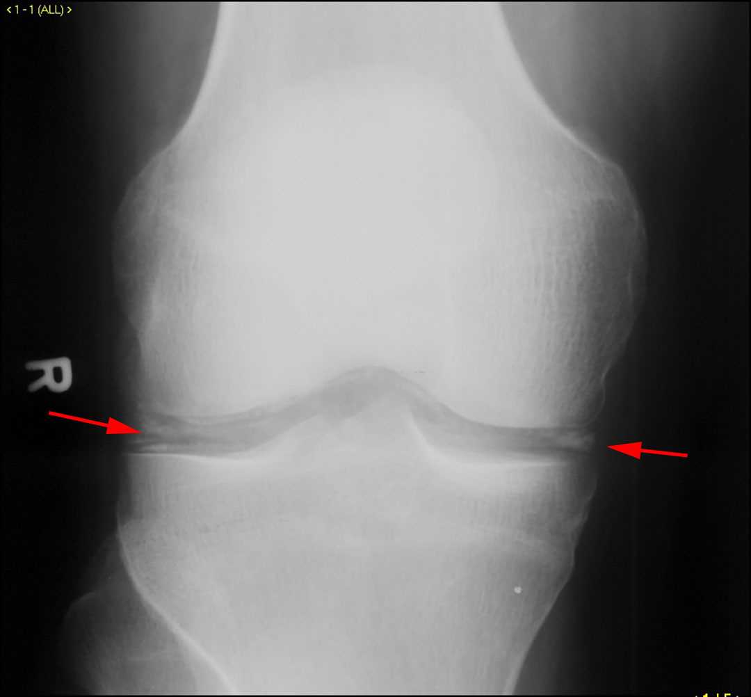 Chondrocalcinosis - CTisus CT Scan