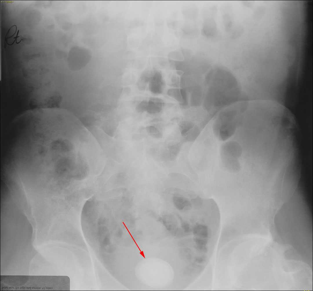 Bladder stone - CTisus CT Scan