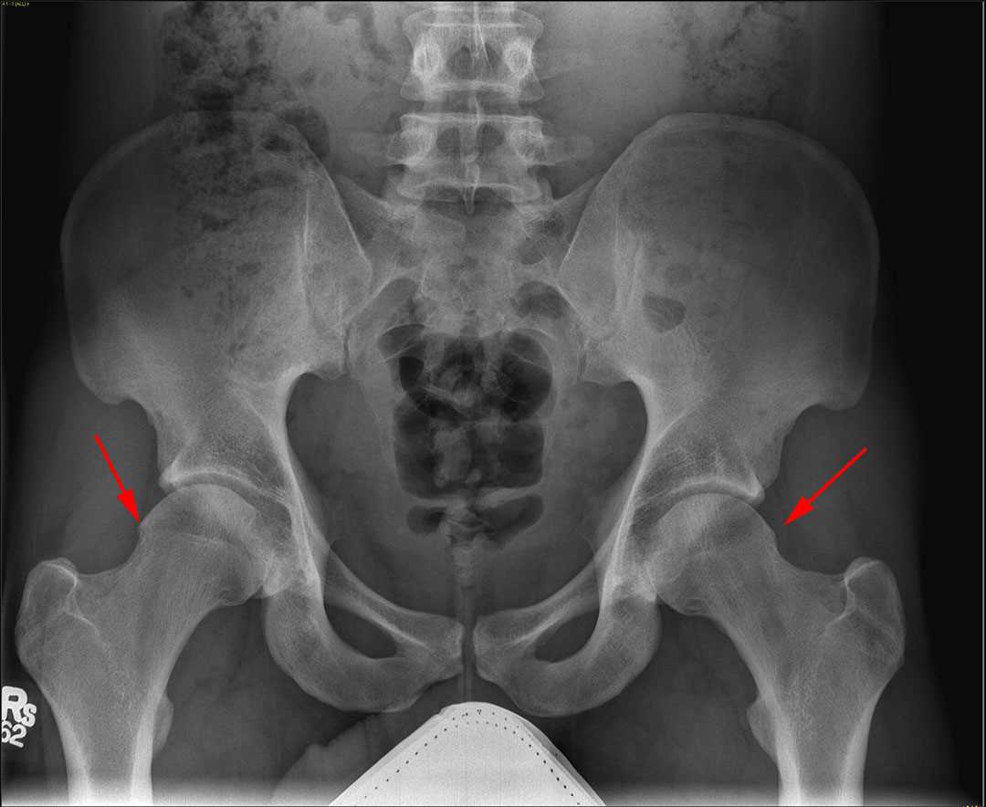Femoroacetabular Impingement (FAI) - CTisus CT Scan