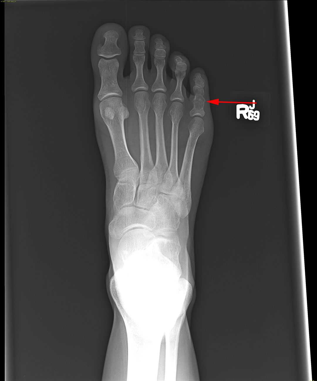 Enchondroma - CTisus CT Scan