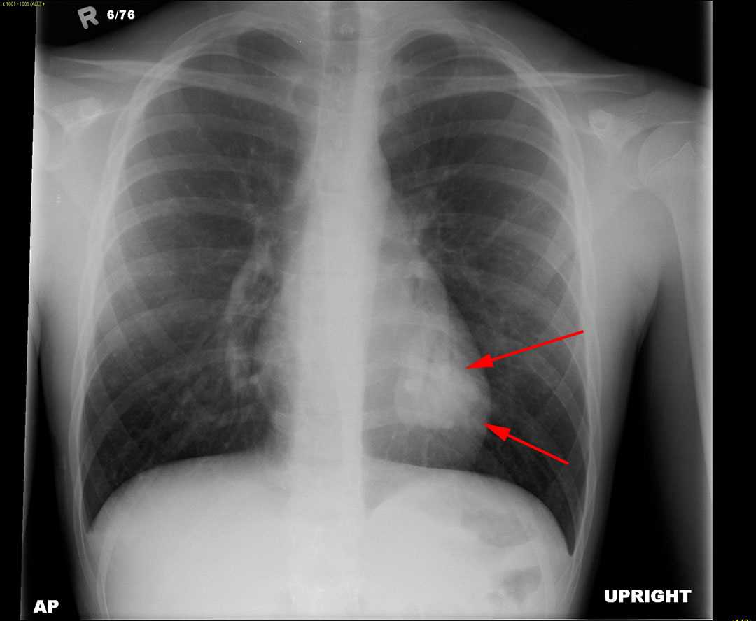Osler-Weber-Rendu syndrome - CTisus CT Scan