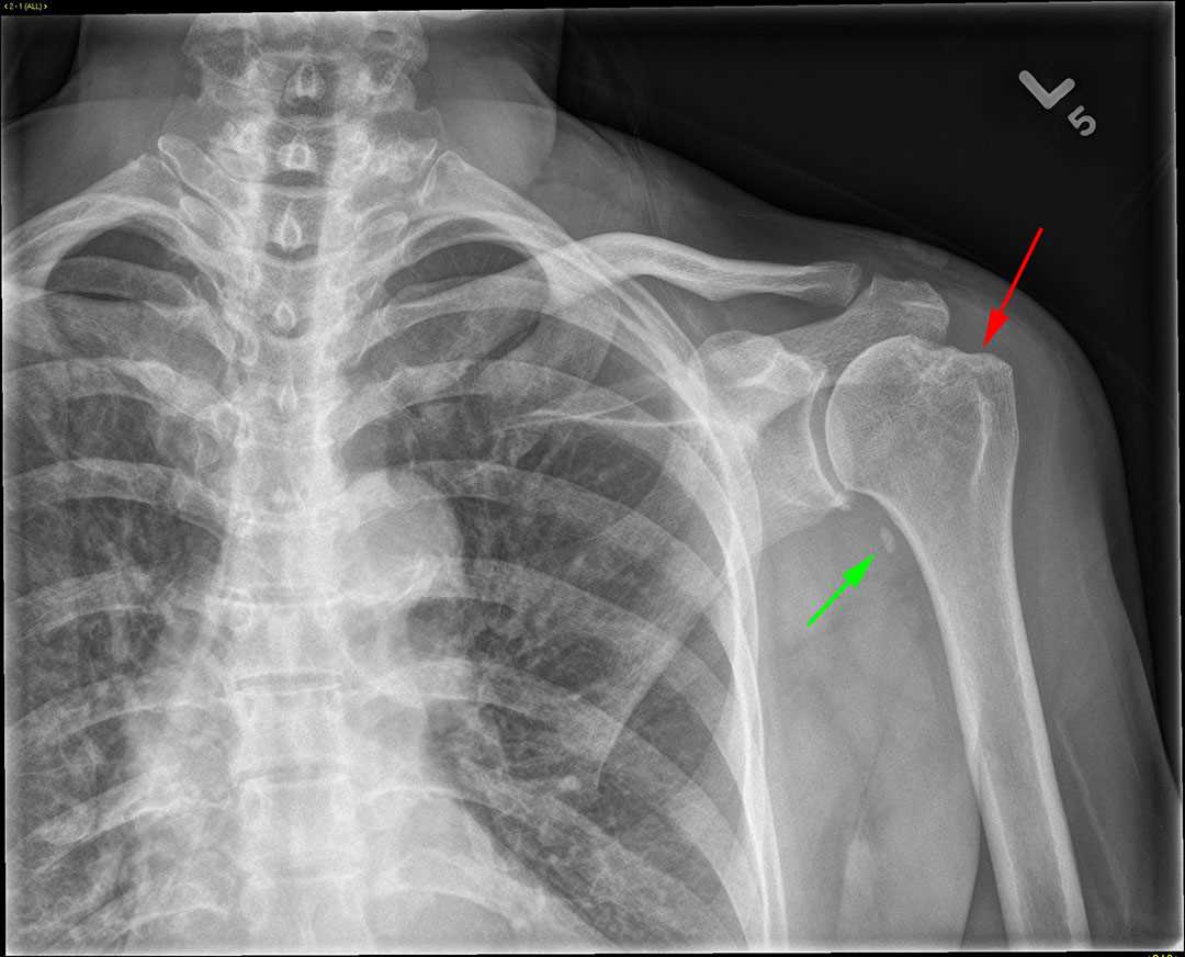 Hill-Sachs Deformity - CTisus CT Scan