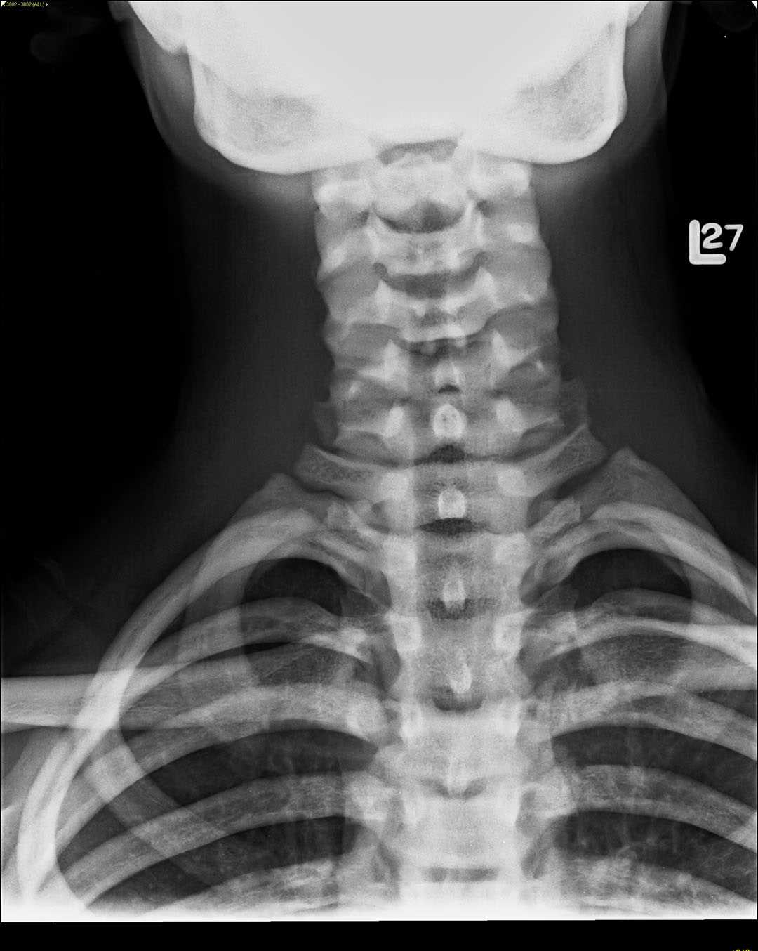 Osteopetrosis - CTisus CT Scan