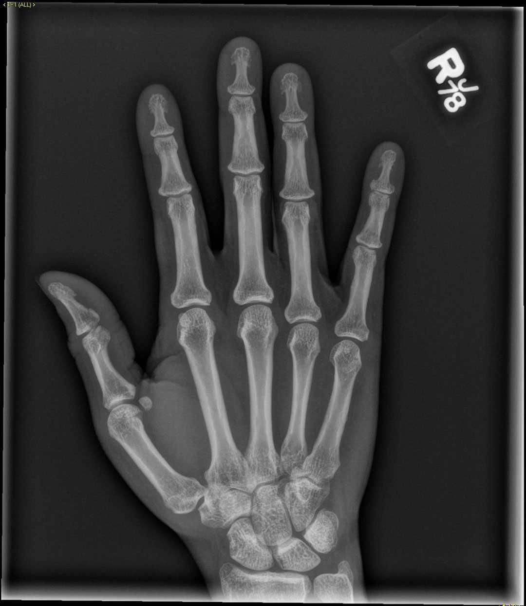 Radial collateral ligament avulsion - CTisus CT Scan